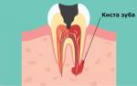 Как избавиться от кисты на зубе