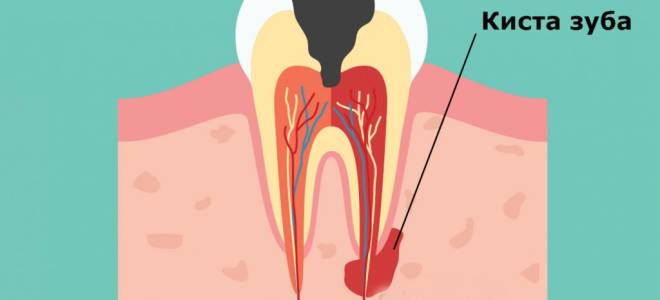 Как избавиться от кисты на зубе