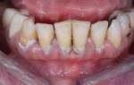 Зубной пародонтоз – что это такое