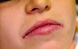 Болячка под нижней губой