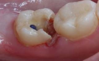 Мышьяк в зубе сколько можно держать