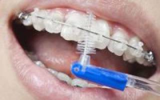 Зубная щетка для брекетов: виды, описание, как выбрать