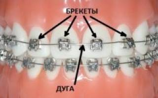 Как делают брекеты