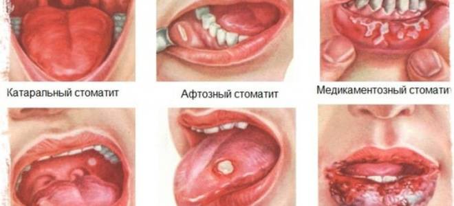 Стоматит таблетки