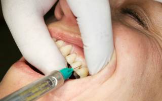 Общий наркоз при лечении зубов