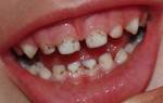 Черные полоски на зубах – как лечить