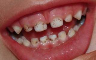 Черные полоски на зубах – как лечить