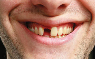 Противопоказания после удаления зуба