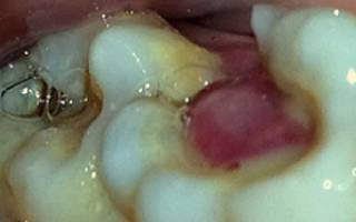 Зуб вылез из десны что делать