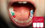 Антибиотики в детской стоматологии