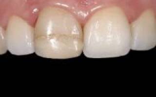 Болят передние зубы нижней челюсти