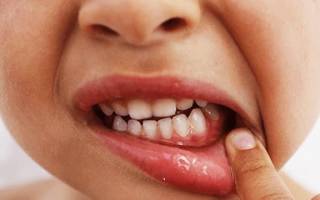 Гингивит при прорезывании зубов