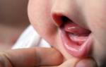 Температура при прорезывании зубов у детей сколько