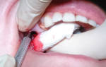 Сколько может кровить после удаления зуба