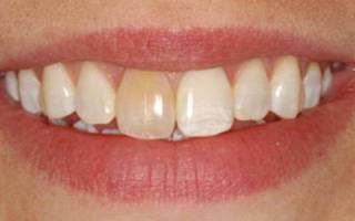 Как лечить гранулему зуба
