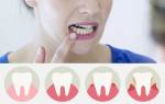 Десны отходят от зубов лечение