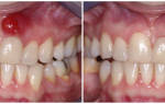 Лечение периостита зуба