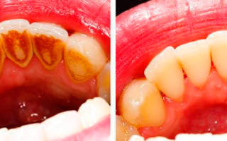 Зубной камень на нижних передних зубах