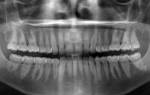 Панорамный снимок зубов что это такое