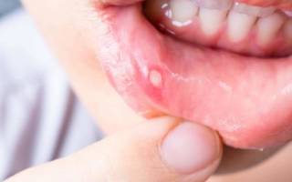 Средство от стоматита во рту у ребенка