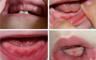 Лекарство при прорезывании зубов у детей