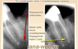 Передонтитный зуб лечение