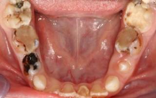 Нужно ли депульпировать зуб под металлокерамику
