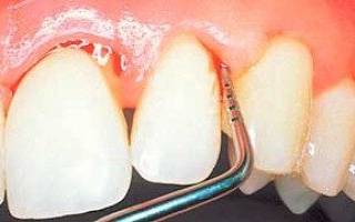 Мазь от пародонтоза зубов