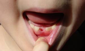 Пульпит молочных зубов у детей лечение