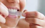 Пластинки для отбеливания зубов – виды и описание