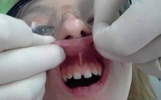 Как подрезают уздечку верхней губы