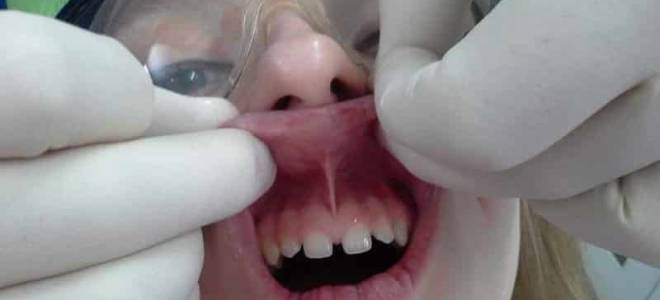 Для чего подрезают уздечку верхней губы