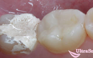 Что делает мышьяк в зубе