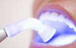 После чистки зубов ультразвуком нельзя