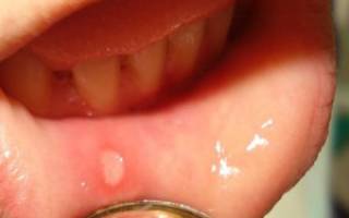 Как быстро вылечить язвочки во рту