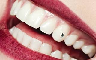 Стразы на зубах – что это и как снять