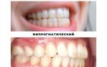 Виды прикусов зубов у человека