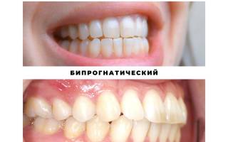 Виды прикусов зубов у человека