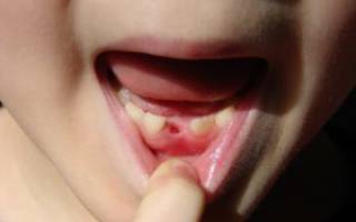 Все ли молочные зубы меняются у детей