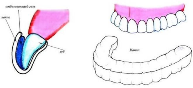 Капы для отбеливания зубов