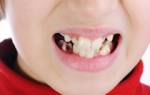 Черные пятна на зубах у ребенка