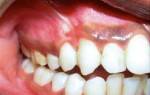Почернение зубов возле десен