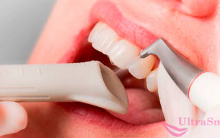 Отбеливание зубов Air Flow — верните улыбке природную белизну!