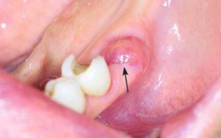 Боль в ухе после удаления зуба