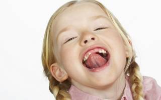 Подрезать уздечку языка ребенку