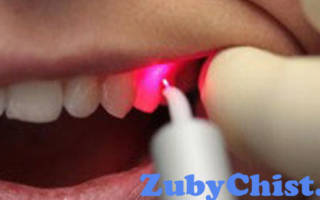 Лечение зубов озоном