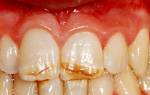 Трещины на эмали зубов лечение
