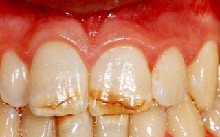 Трещины на эмали зубов лечение