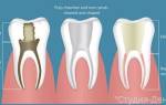 Как пломбируют каналы зуба