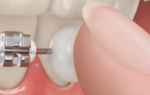 Воск стоматологический для брекетов